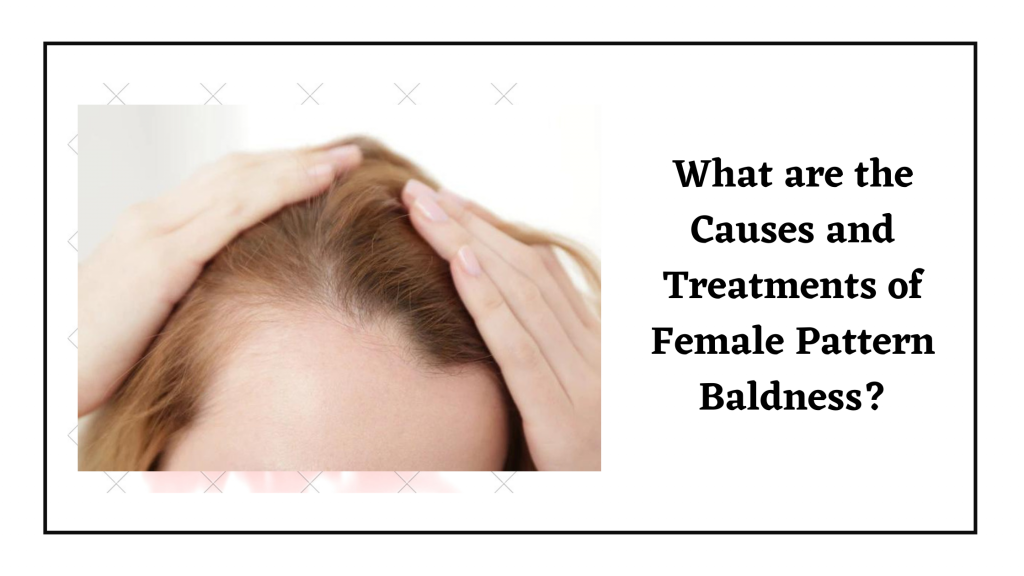 What are the Causes and Treatments of Female Pattern Baldness