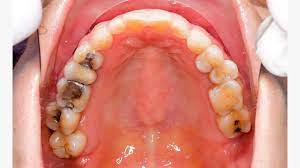 composite tooth filling