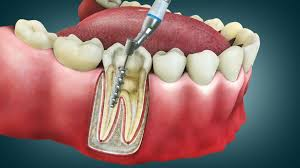 What Lynbrook Residents Should Know Before Starting Any Major Dental Treatment Lynbrook Residents